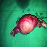 Resection of rib tumor