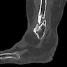 CT left ankle, sagittal view