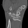 CT of scaphoid, coronal view