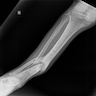 Xray of mid leg fracture