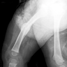 Xray of femoral fracture