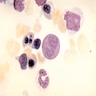 Eosinophilic metamyelocyte