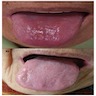 Glossitis, smooth tongue