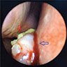 Nasal cavity osteoma with actinomycosis