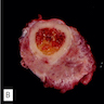 Tumor encircling bone