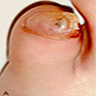 Subungual exostosis of right fifth toe