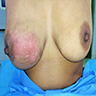 Lump in the right breast