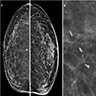 Linear, tortuous, noncalcified opacities (right); serpiginous, linear and discontinuous calcifications (calcified worms, left)
