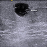 Cyst with few linear echogenic foci (arrow)