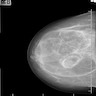 Mammographic findings