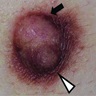 Left nipple (white arrow), nodule (black arrow)