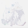 p63: variable myoepithelial and luminal staining