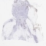 Pleomorphic lobular carcinoma, E-cadherin stain