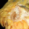 Gross mass in the breast