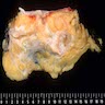Gross mass in the breast