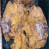Cystic area with necrosis (upper), gray-white solid area (below)