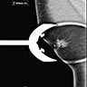 Mammography shows a spiculated mass with associated nipple retraction and skin thickening