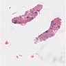 Fibromatosis-like metaplastic carcinoma