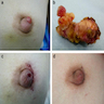 Nipple adenoma, preoperative and postconservative excision