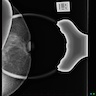 Mammography, ultrasound and MRI of palpable left nipple mass with clear nipple discharge