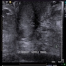 Mammography, ultrasound and MRI of palpable left nipple mass with clear nipple discharge