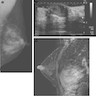 Mammography, sonography and MRI images of nipple adenoma