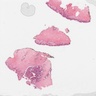 Nipple adenoma papillomatous pattern