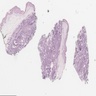 Nipple adenoma florid usual ductal hyperplasia