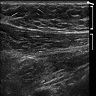 Accessory breast tissue on ultrasound