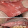 Oral linear epidermal nevus