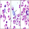 Trophozoites on CSF cytological examination