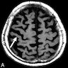 Axial T2 weighted MRI