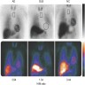Low uptake in myocardial scintigraphy