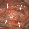 Spinal RGNT, intraoperative picture