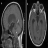 MRI of pineal region and third ventricle RGNT
