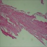 Sheets of rhabdoid cells