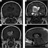 MRI brain, unenhanced and enhanced