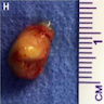 endoscopically excised colloid cyst