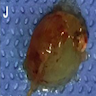 endoscopically excised colloid cyst