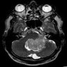 MRI: ependymoma of fourth ventricle