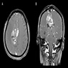 Solid / cystic with leptomeningeal involvement