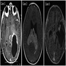 Left temporal lobe mass, MRI