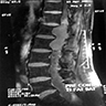 Scalloping of lumbar vertebrae