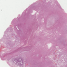 Pilocytic astrocytoma (grade I)