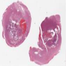 Pleomorphic xanthoastrocytoma