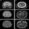 FLAIR, CT scan and T1 postcontrast