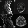 Spinal cord subependymoma, MRI