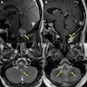 Fourth ventricle subependymoma