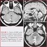 MRI of cerebellar vermis RGNT