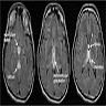 FLAIR images of acute Wernicke encephalopathy